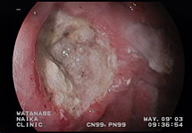 胃内視鏡検査　症例1-1
