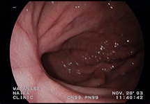 胃内視鏡検査　症例1-2