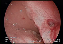 胃内視鏡検査　症例2-1