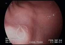 胃内視鏡検査　症例3