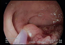 大腸内視鏡検査　症例2-2