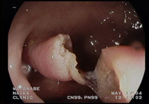 大腸内視鏡検査　症例2-3