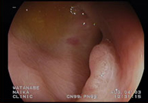 大腸内視鏡検査　症例3-1