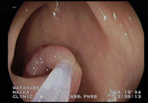 大腸内視鏡検査　症例4-2